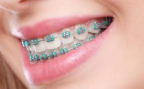 Orthodontic Treatment