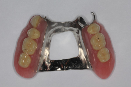 Complete Dentures