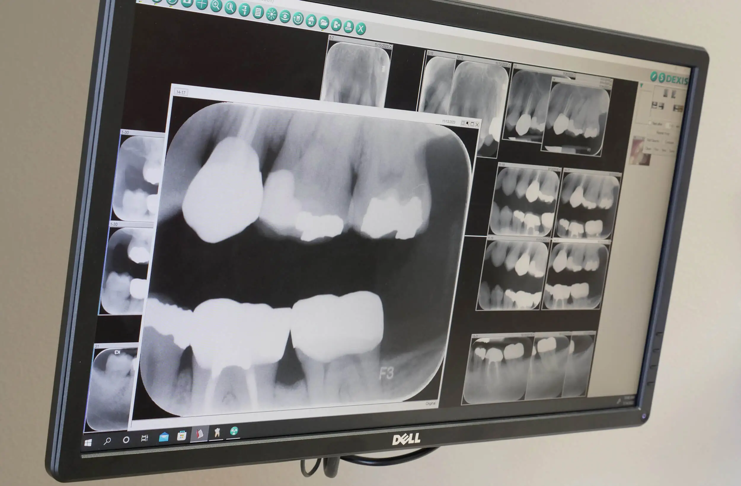 Dental Diagnosis Using Digital X-rays