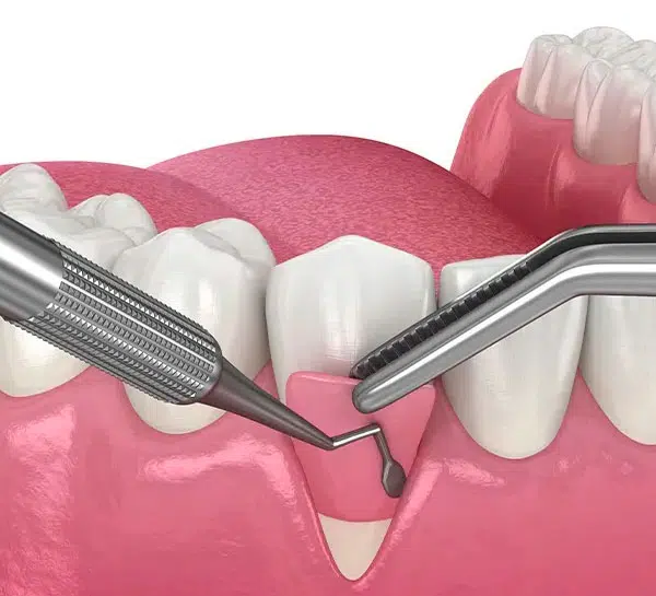 Flap Surgery Procedure