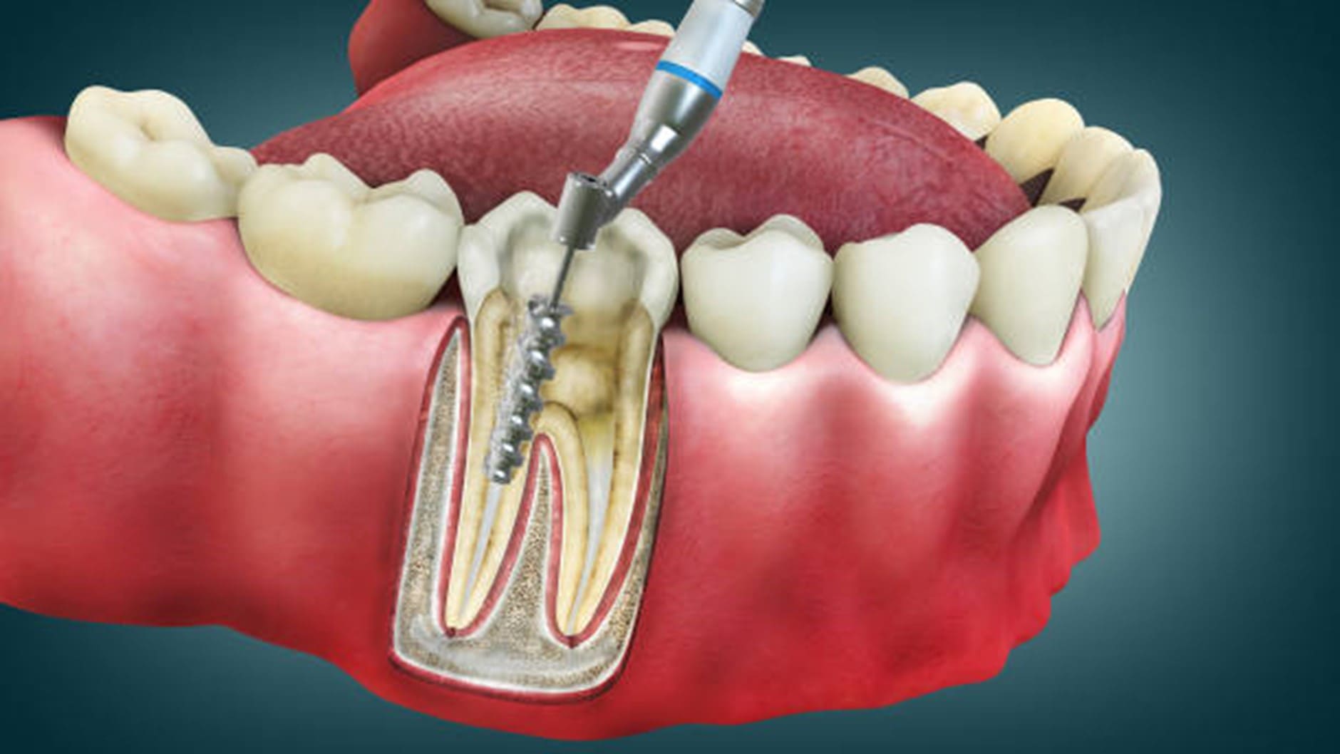 Root Canal Tools
