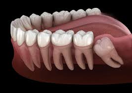 Oral Surgeries